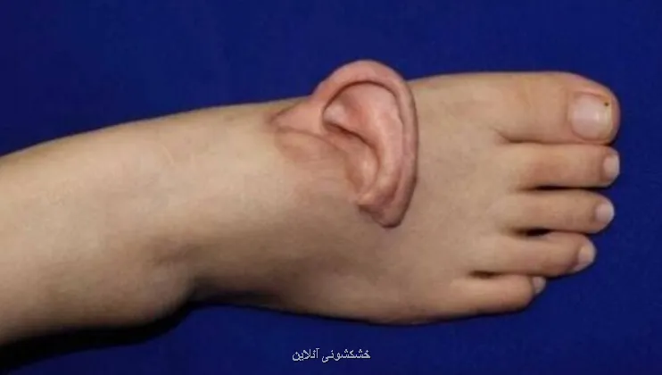 نجات لاله گوش زن چینی با پیوند موقت روی پا