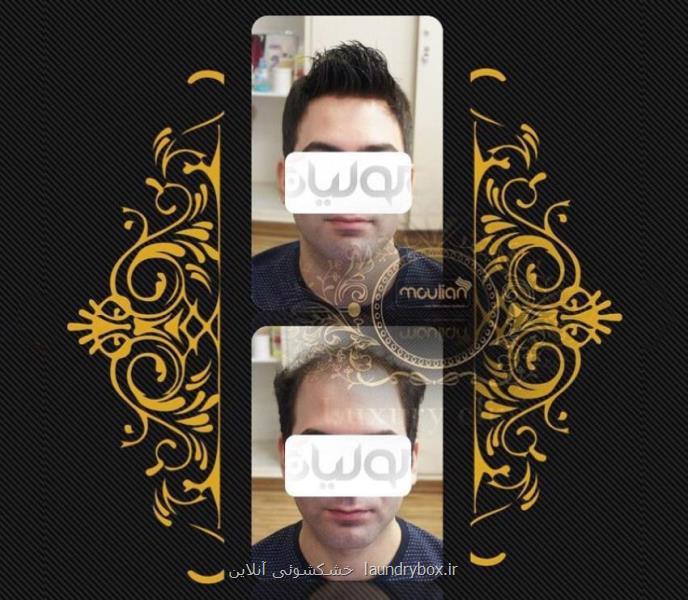ترمیم مو به صورت تار به تار